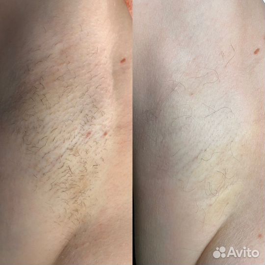 Электроэпиляция