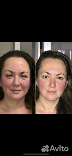 Пластифицирующий Мануальный массаж лица