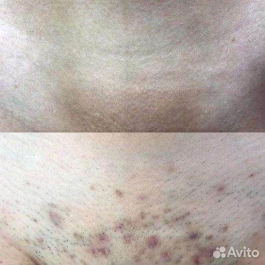 Шугаринг на дому