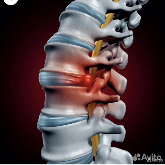 Главный Костоправ Грыжа Сколиоз Лордоз позвоноч