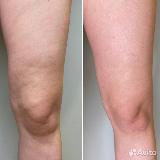 Холодная плазма, омоложение, лечение целлюлита