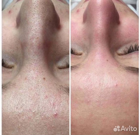 Карбоновый пилинг