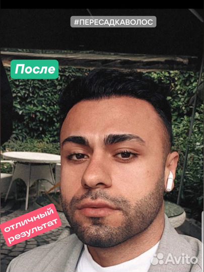 Пересадка волос