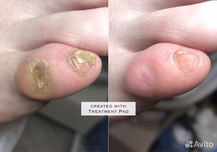 Мед. педикюр. Титановая нить. Подолог