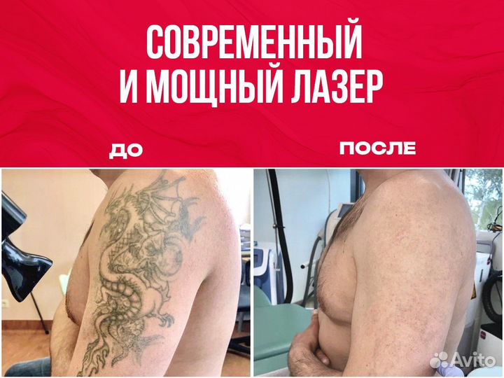 Лазерное удаление татуировки, татуаж, перманент