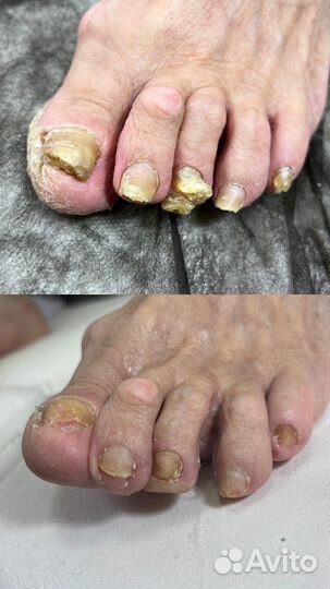 Медицинский педикюр