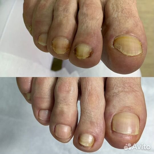 Медицинский педикюр подолог