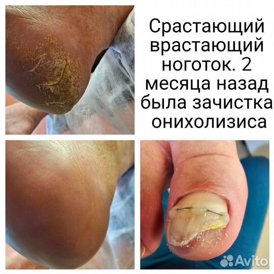 Подолог: вросший ноготь, трещины, мозоли,натоптыши