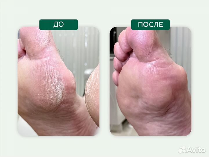 Медицинский, подологический педикюр, подолог