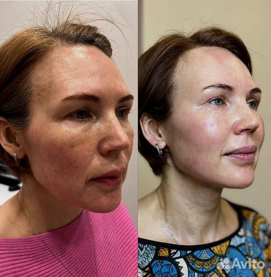 Аппарат РФ лифтинга