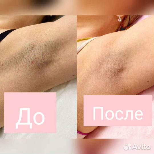 Лазерная эпиляция/элос эпиляция