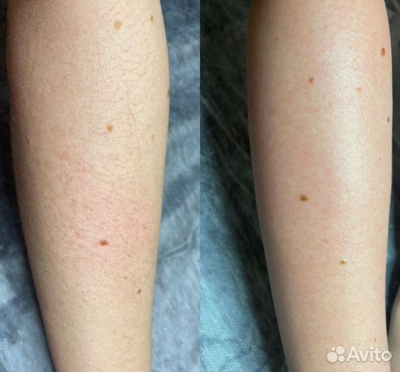 Шугаринг/воск/депиляция