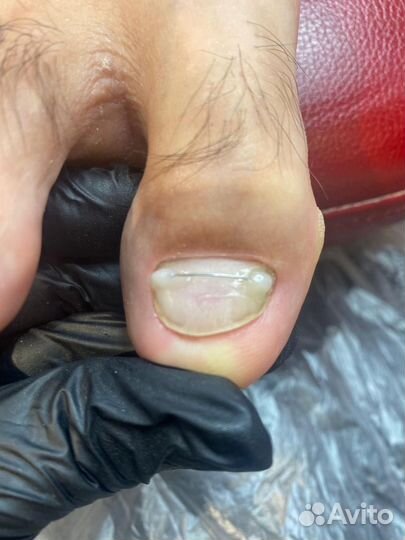 Медицинский педикюр, подолог