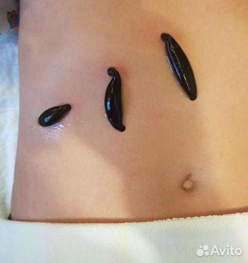 Купон на гирудотерапию