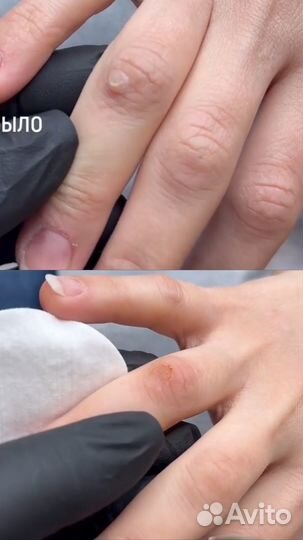 Удаление папиллом