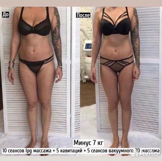 Аппаратный массаж (LPG, 3d и др.)