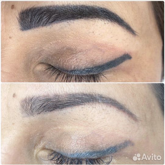 Удаление татуажа, татуировок неодимовым лазером