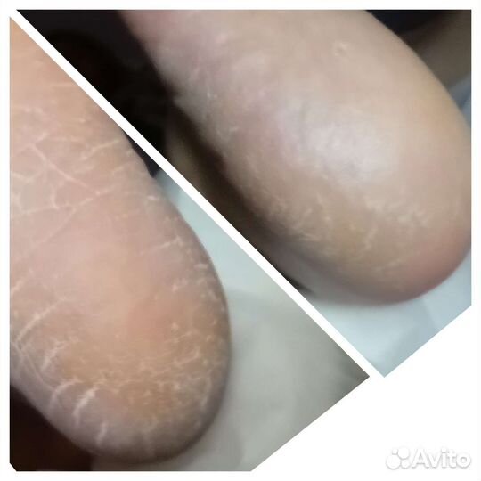 Подолог, выезд на дом(Мед.педикюр)шугар. депиляция