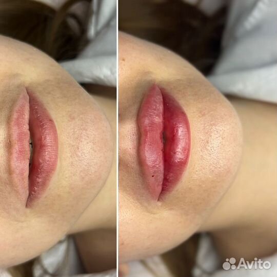 Увеличение губ