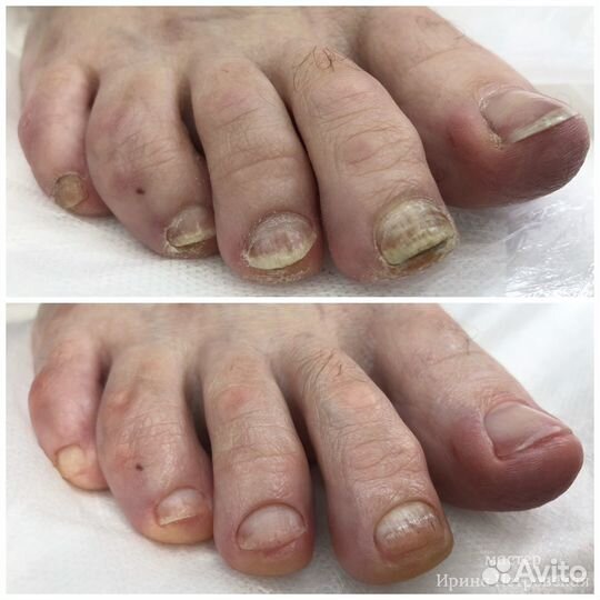 Педикюр. Подология