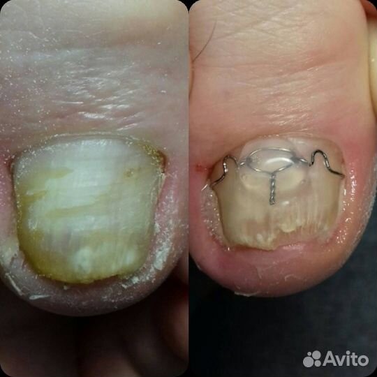 Педикюр. Подология. Ортониксия