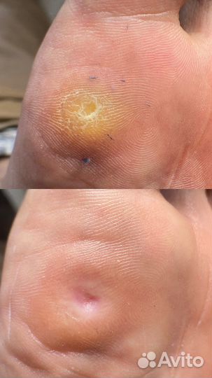 Педикюр подолог