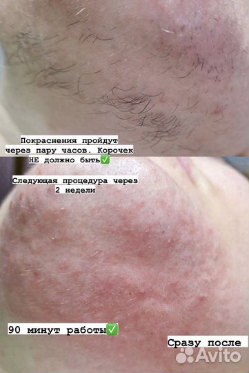 Электроэпиляция