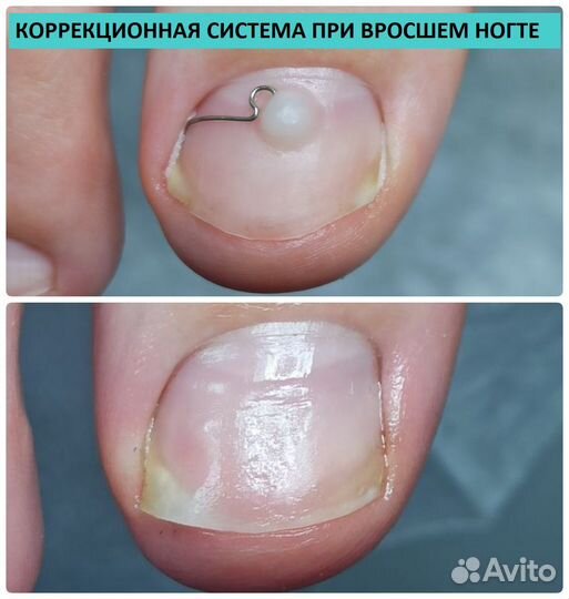 Медицинский педикюр. подолог