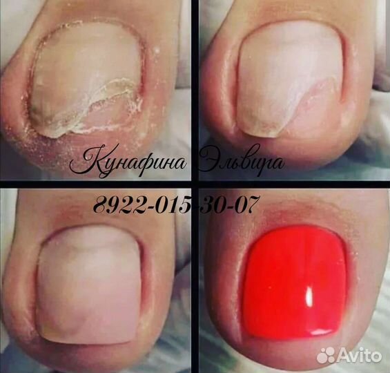 Маникюр, педикюр,с вросшими,деформ-ными,ногтями