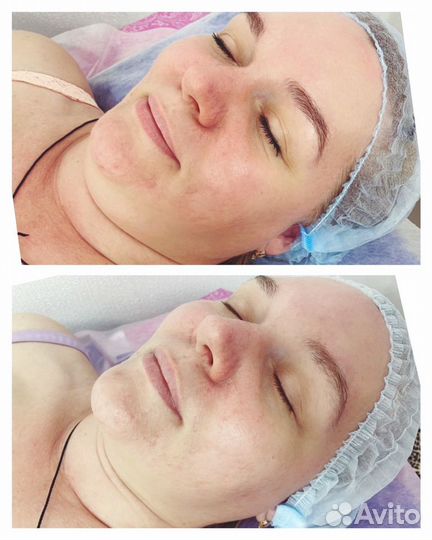 Вакуум Кавитация RF лифтинг Миостимуляция