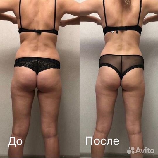 Антицеллюлитный массаж