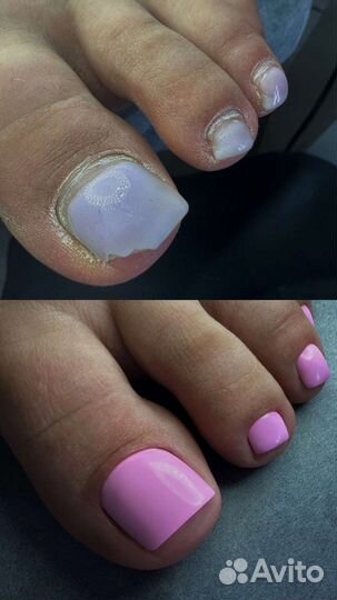 Аппаратный педикюр