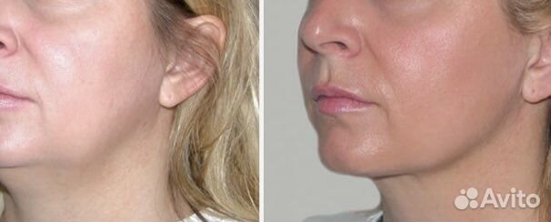 Липолитики лицо тело