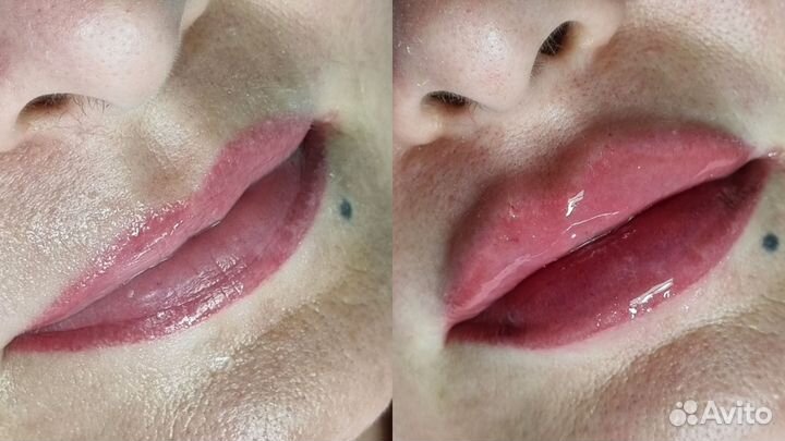 Увеличение губ