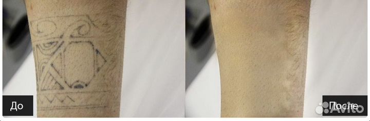 Лазерное удаление тату