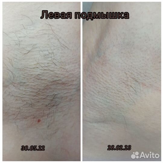Электроэпиляция