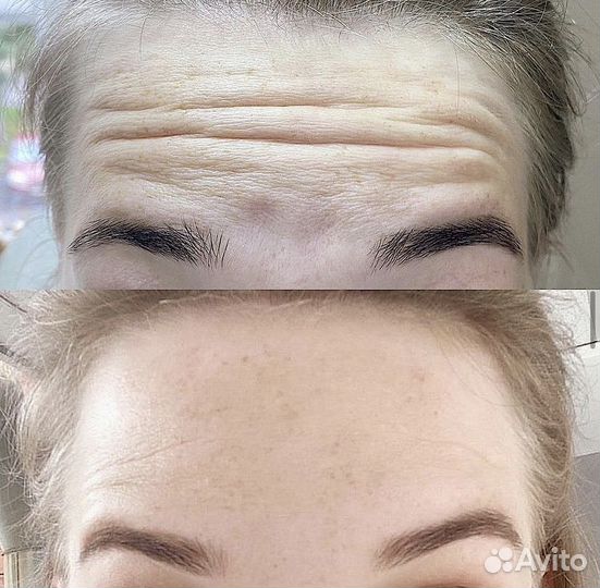 Косметолог. Челюстно-лицевой хирург. Ботокс