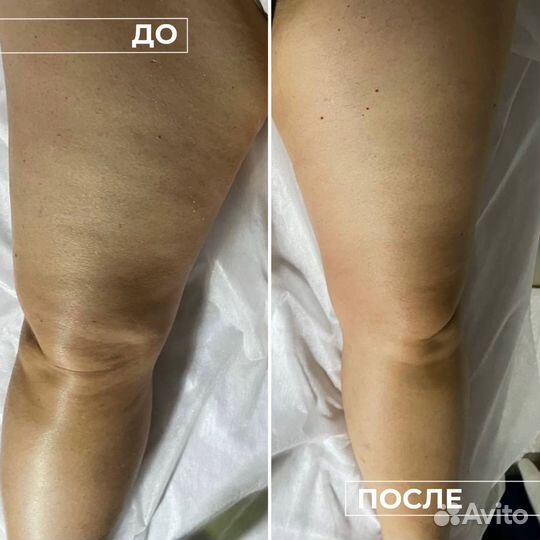 Эндосфера массаж, коррекция фигуры