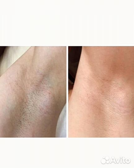 Лазерная эпиляция диодный лазер