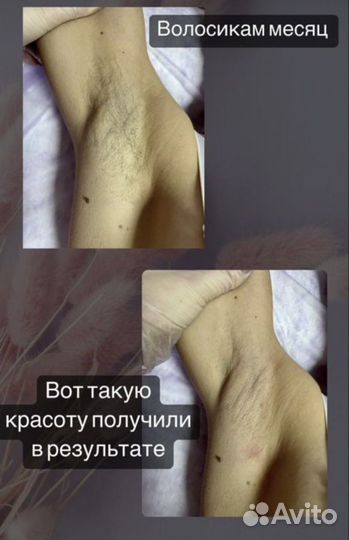 Депиляция