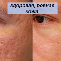Лазерная шлифовка рубцов шрамов на со2 Fotona, Москва