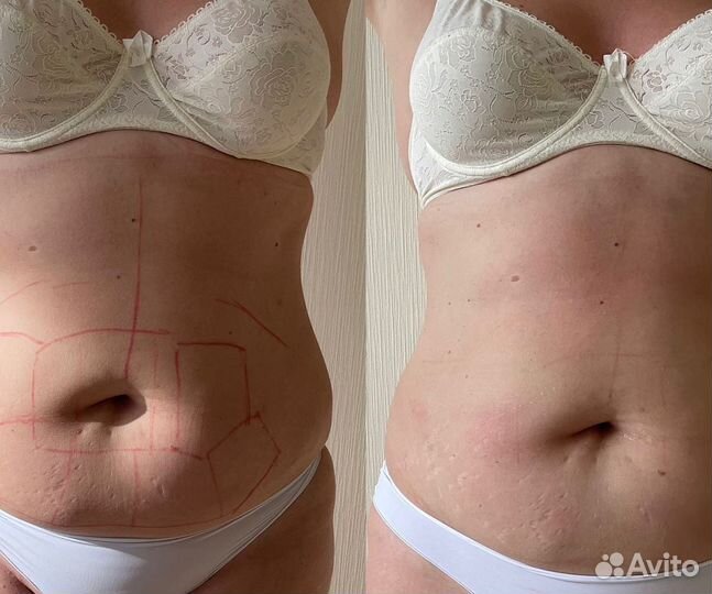 Коррекция фигуры Липосоникс -3см за одну процедуру