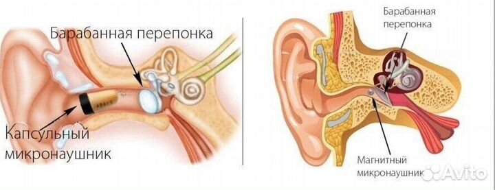 Микронаушник капсульный