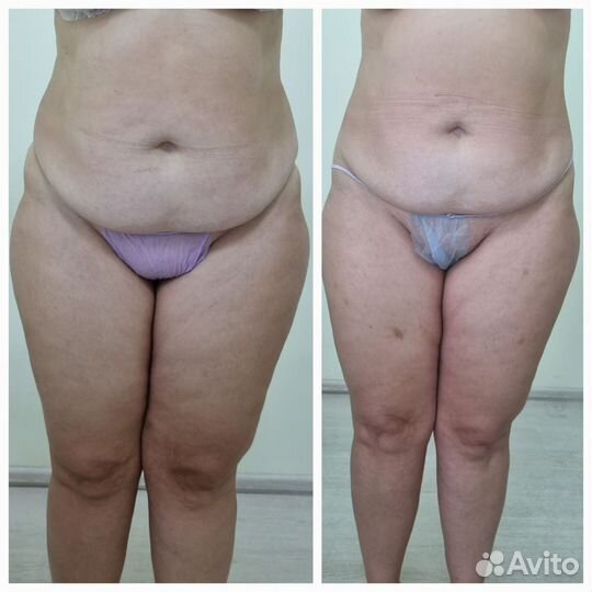 Аппаратный LPG массаж. Ручной массаж