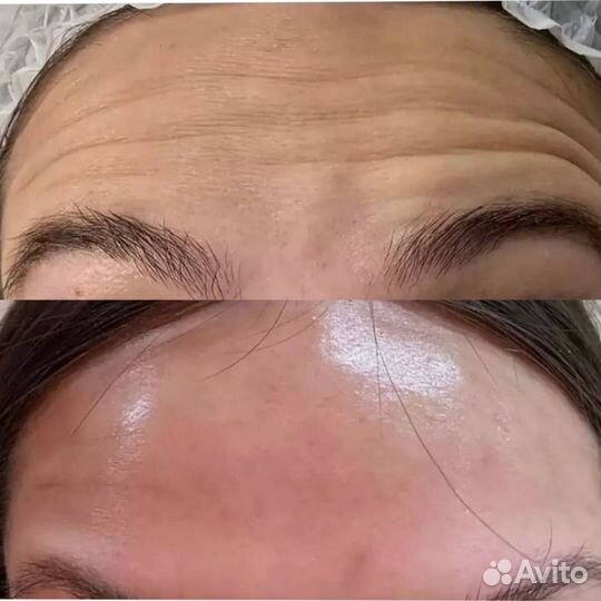 Модель на ботокс лица