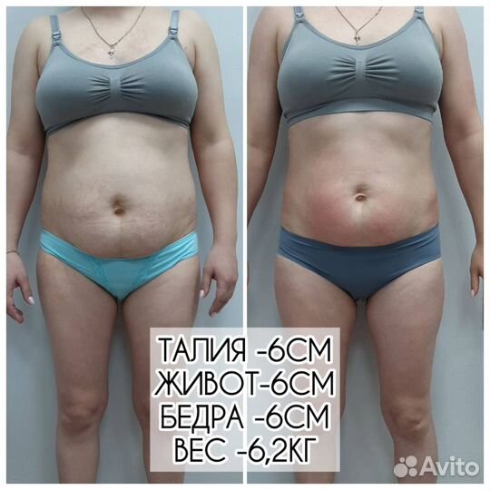 Коррекция фигуры и лица. Кавитация, pф RF лифтинг