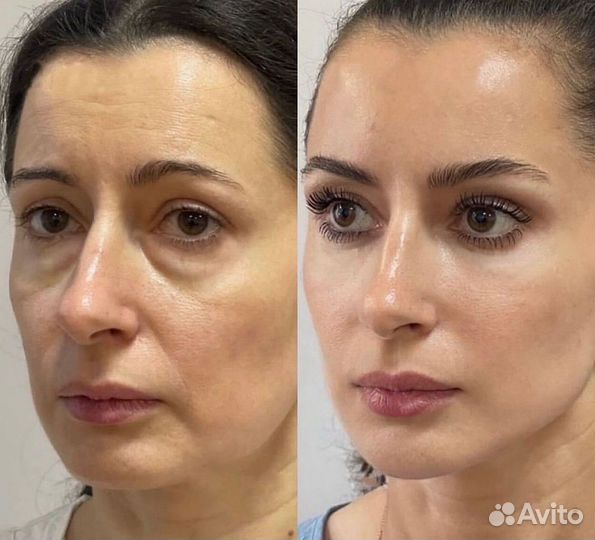 Косметолог: Лицо под ключ, филлеры