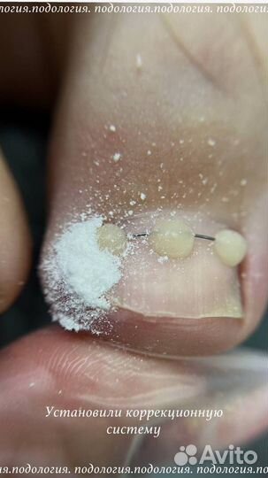 Подолог, вросший ноготь, титановая нить, педикюр