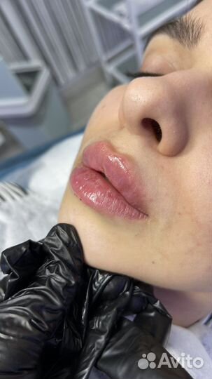 Увеличение губ