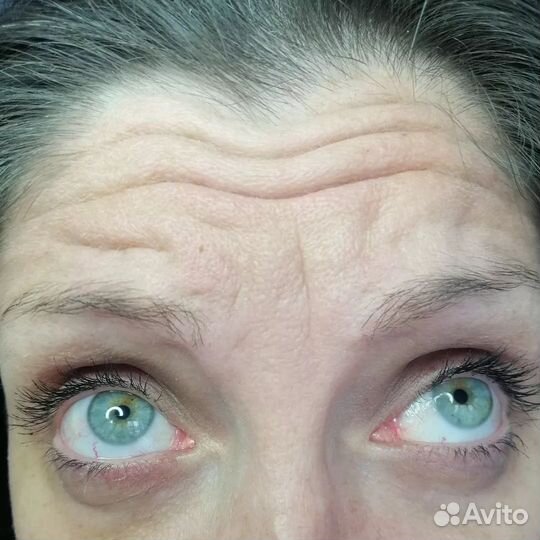 Ботокс для лица плюс коррекция бесплатно